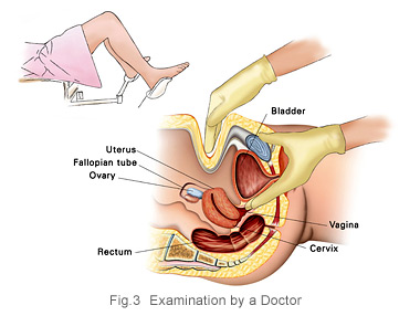 Physical Examination - Ovarian Cancer