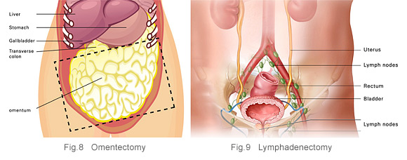 (omentectomy) and lymph nodes (lymphadenectomy).