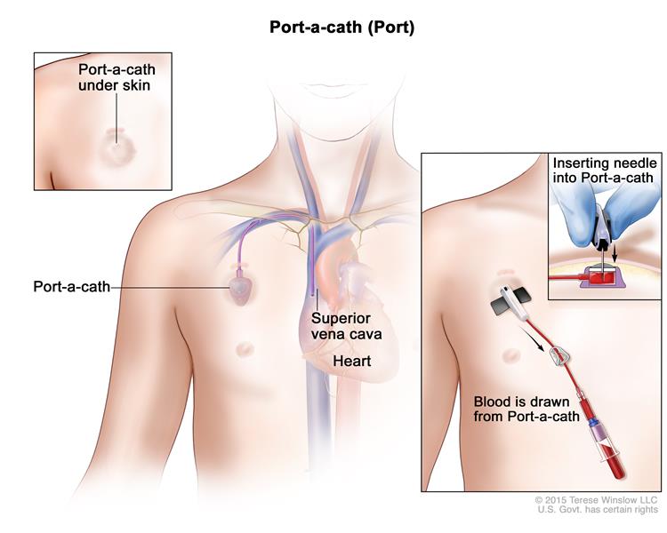 chemotherapy treatment port-a-cath