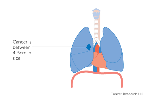 Diagram of Stage 2A Lung Cancer by Cancer Research UK﻿