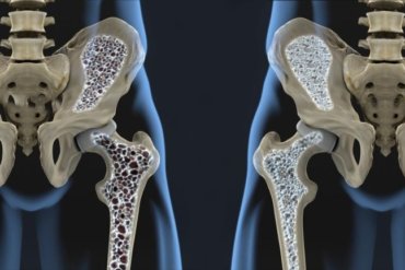 Understanding Osteoporosis Risks Treatment Home Care Services