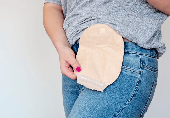 Understanding Stoma Care | Guidelines, Types & Home Care Services